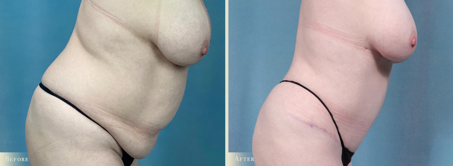Colorado Plastic Surgery tummy tuck result — Denver, CO