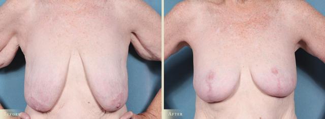 Breast Lift result at Colorado Plastic Surgery in Denver, CO