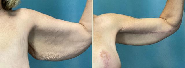 Arm Lift result at Colorado Plastic Surgery in Denver, CO