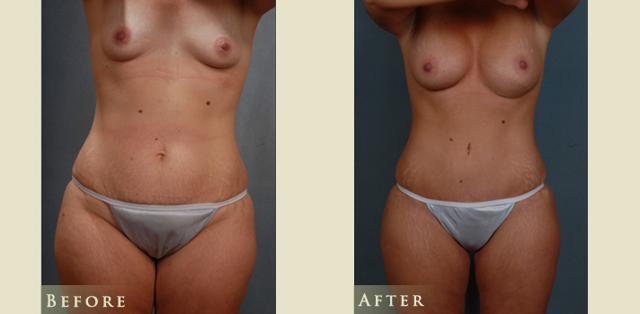 Mommy Makeover result at Colorado Plastic Surgery in Denver, CO