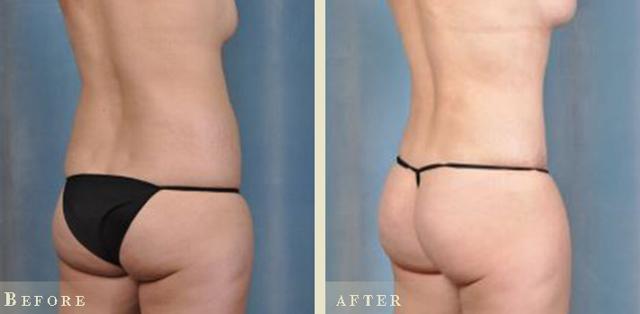 Brazilian Butt Lift result at Colorado Plastic Surgery in Denver, CO