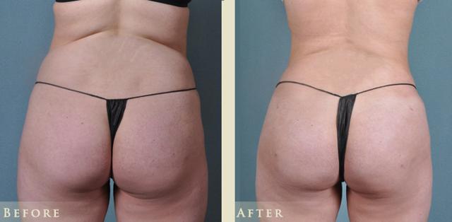 Brazilian Butt Lift result at Colorado Plastic Surgery in Denver, CO
