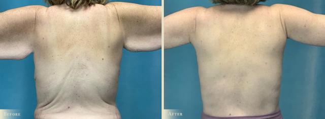 Arm Lift result at Colorado Plastic Surgery in Denver, CO