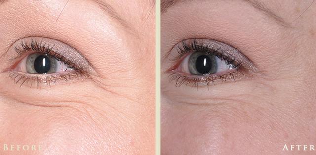 Botox result at Colorado Plastic Surgery in Denver, CO