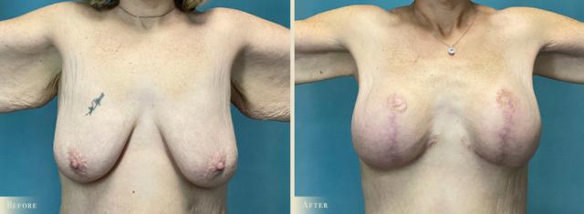 Arm Lift result at Colorado Plastic Surgery in Denver, CO