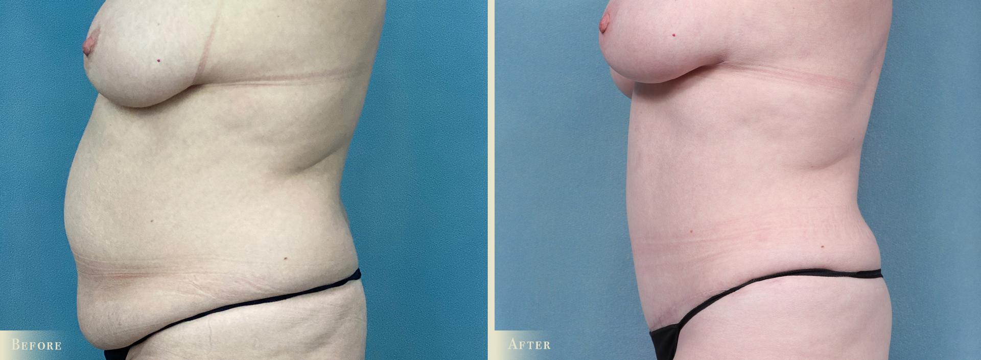 Colorado Plastic Surgery tummy tuck result — Denver, CO