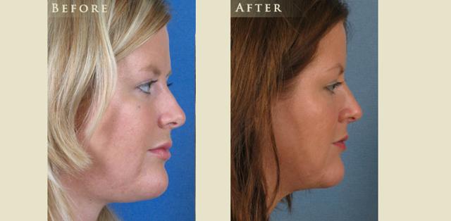 Mini Facelift result at Colorado Plastic Surgery in Denver, CO