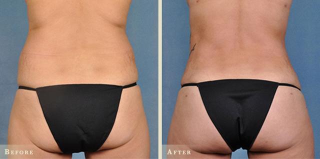 Brazilian Butt Lift result at Colorado Plastic Surgery in Denver, CO