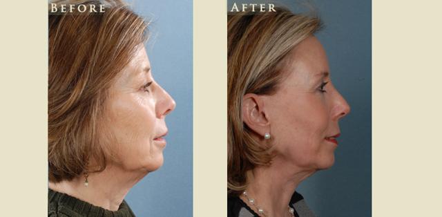 Facelift result at Colorado Plastic Surgery in Denver, CO