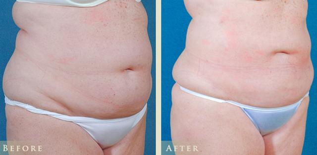 Liposuction result at Colorado Plastic Surgery in Denver, CO