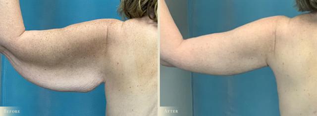 Arm Lift result at Colorado Plastic Surgery in Denver, CO