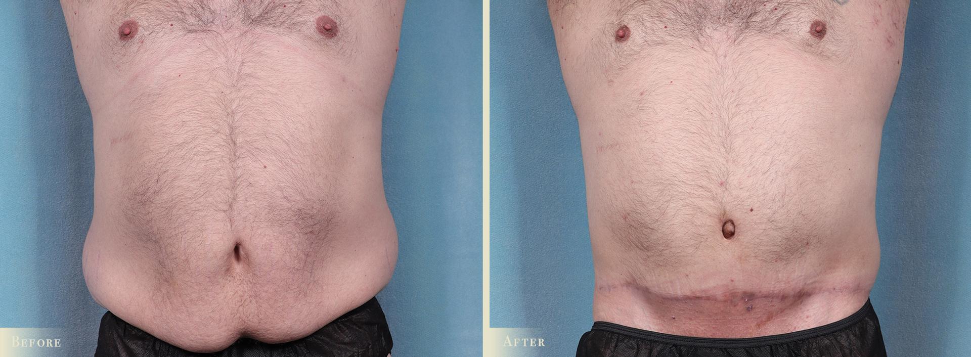 Colorado Plastic Surgery tummy tuck result — Denver, CO