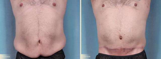Tummy Tuck result at Colorado Plastic Surgery in Denver, CO