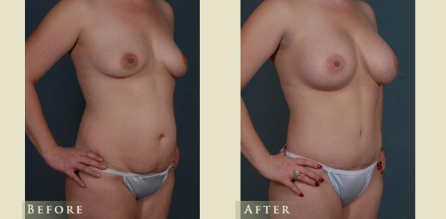 Mommy Makeover result at Colorado Plastic Surgery in Denver, CO