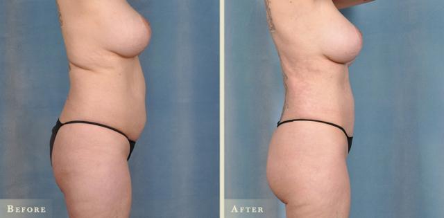 Brazilian Butt Lift result at Colorado Plastic Surgery in Denver, CO
