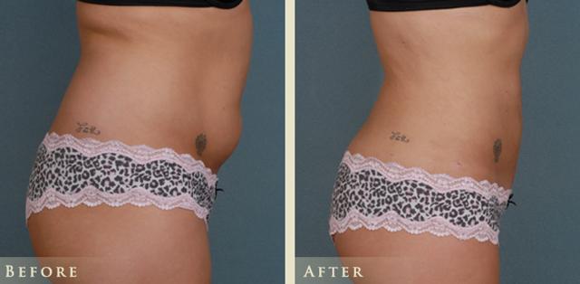 Liposuction result at Colorado Plastic Surgery in Denver, CO