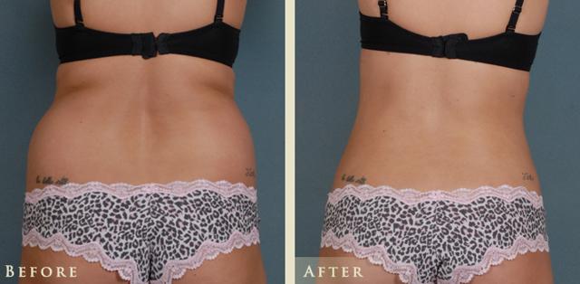 Liposuction result at Colorado Plastic Surgery in Denver, CO
