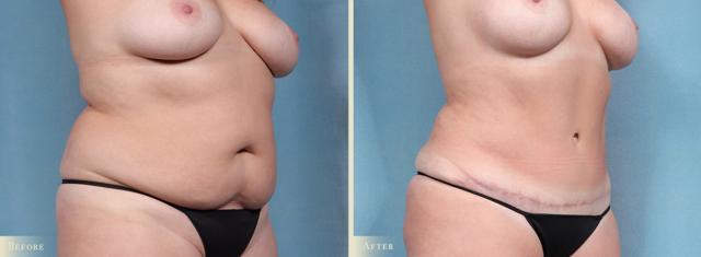 Tummy Tuck result at Colorado Plastic Surgery in Denver, CO