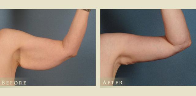 Arm Lift result at Colorado Plastic Surgery in Denver, CO