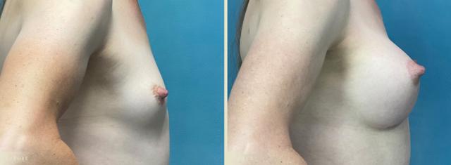 Breast Augmentation result at Colorado Plastic Surgery in Denver, CO