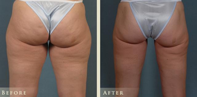 Liposuction result at Colorado Plastic Surgery in Denver, CO