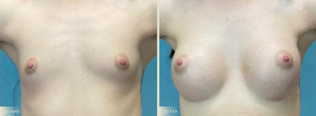 Breast Augmentation result at Colorado Plastic Surgery in Denver, CO