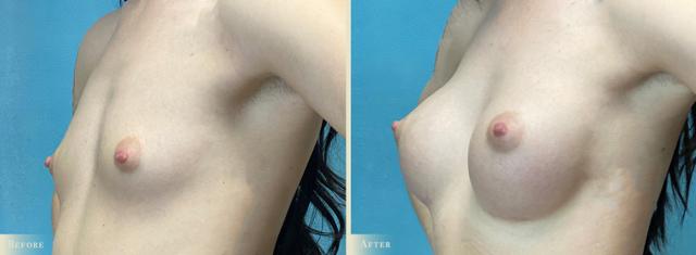 Breast Augmentation result at Colorado Plastic Surgery in Denver, CO