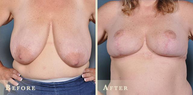 Breast Reduction result at Colorado Plastic Surgery in Denver, CO