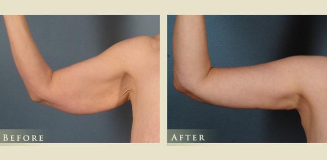 Arm Lift result at Colorado Plastic Surgery in Denver, CO