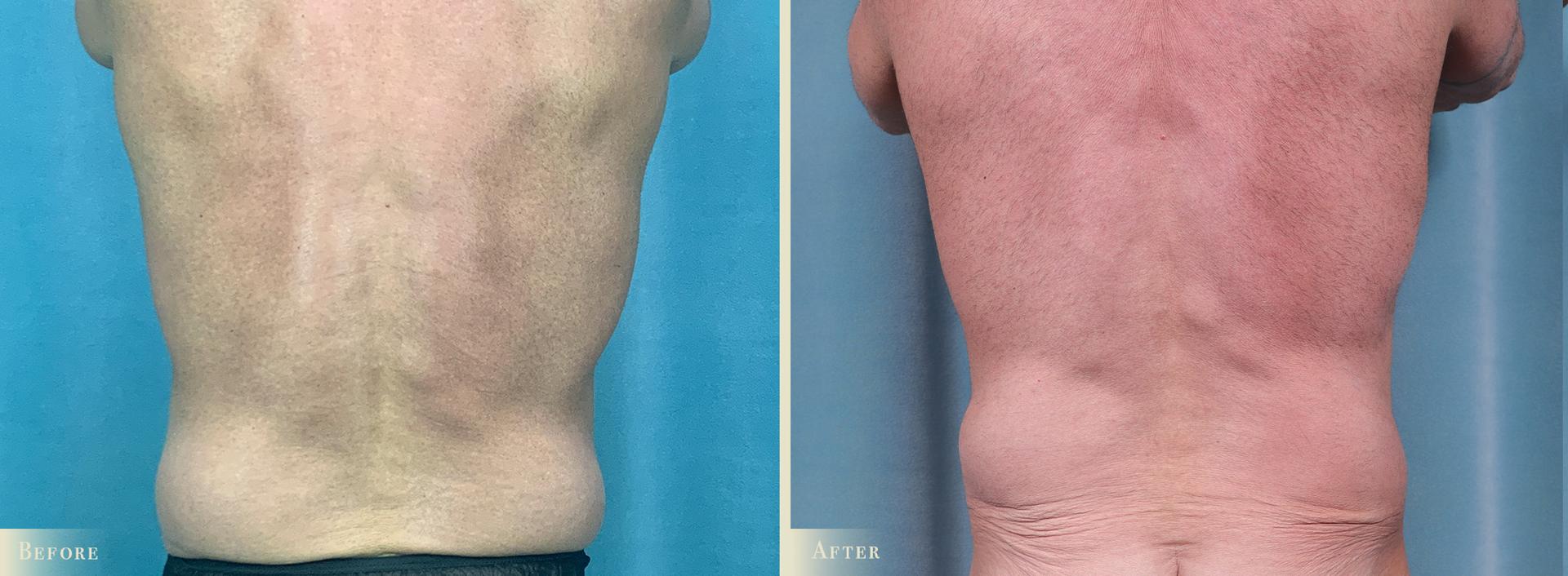 Colorado Plastic Surgery tummy tuck result — Denver, CO