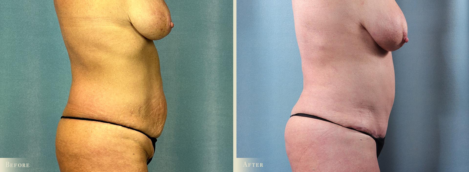 Colorado Plastic Surgery tummy tuck result — Denver, CO