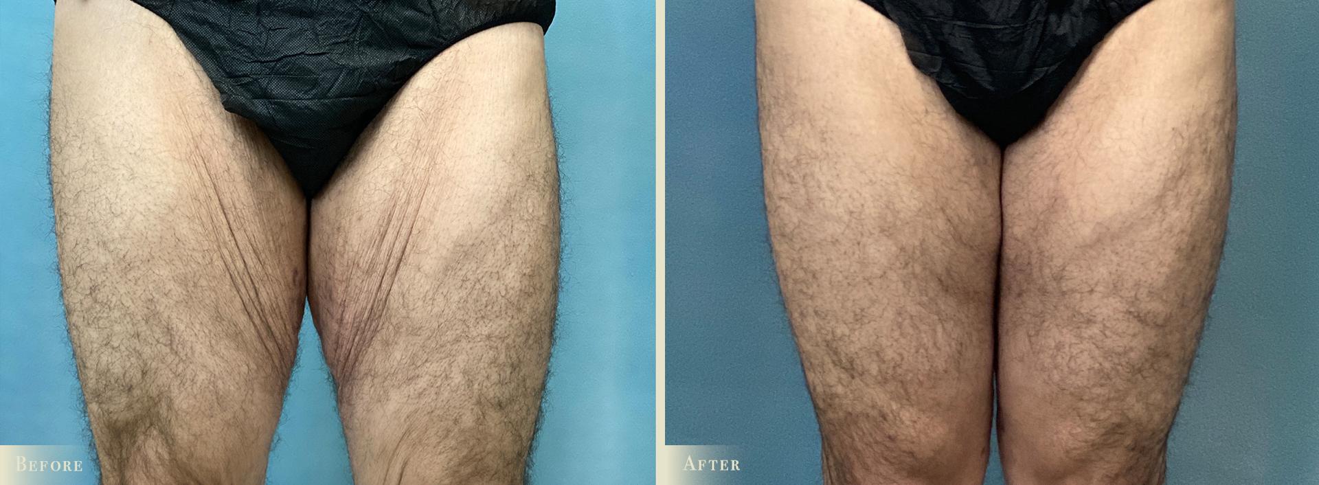 Colorado Plastic Surgery thigh lift result — Denver, CO