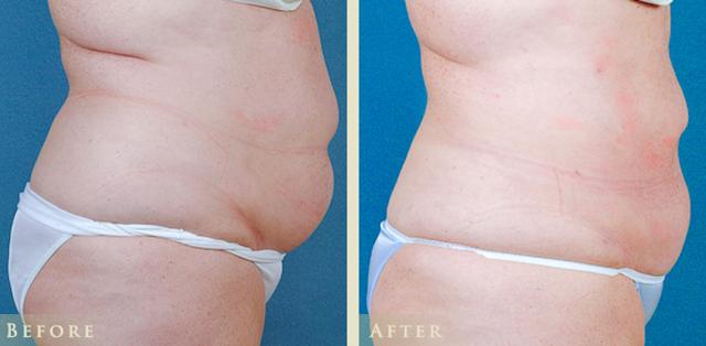 Liposuction result at Colorado Plastic Surgery in Denver, CO