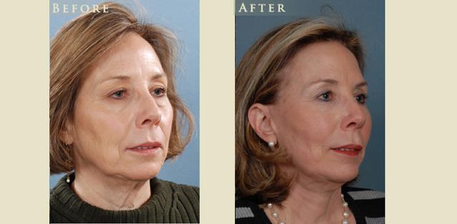 Facelift result at Colorado Plastic Surgery in Denver, CO