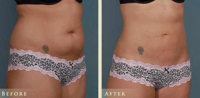 Liposuction result at Colorado Plastic Surgery in Denver, CO