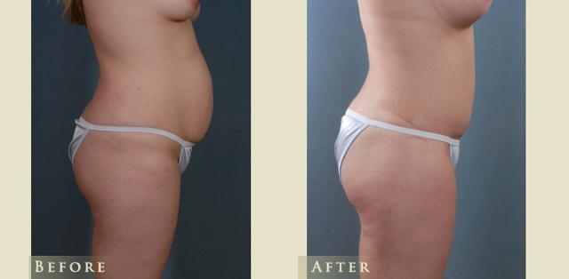 Mommy Makeover result at Colorado Plastic Surgery in Denver, CO