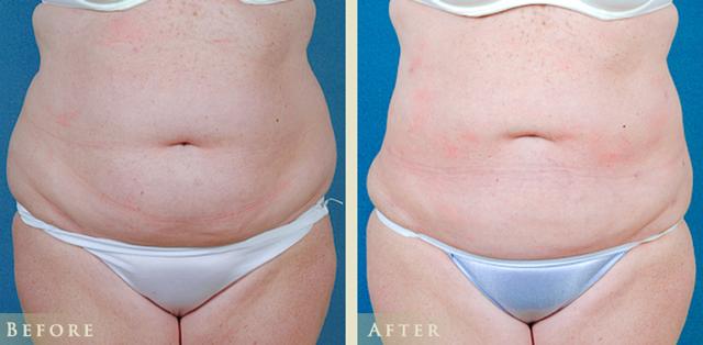 Liposuction result at Colorado Plastic Surgery in Denver, CO