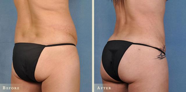 Brazilian Butt Lift result at Colorado Plastic Surgery in Denver, CO