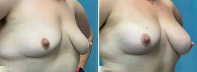 Fat Transfer result at Colorado Plastic Surgery in Denver, CO