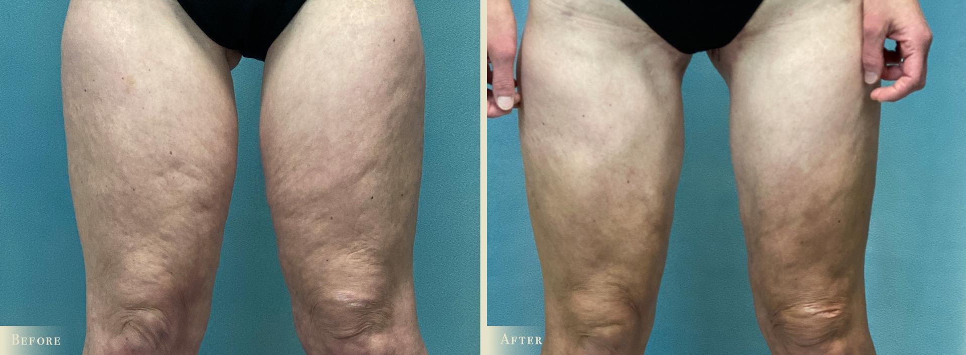 Colorado Plastic Surgery thigh lift result — Denver, CO