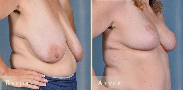 Breast Reduction result at Colorado Plastic Surgery in Denver, CO