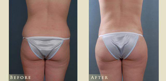 Mommy Makeover result at Colorado Plastic Surgery in Denver, CO