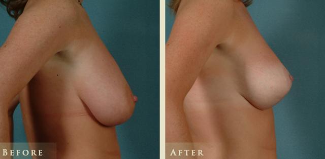 Breast Lift result at Colorado Plastic Surgery in Denver, CO