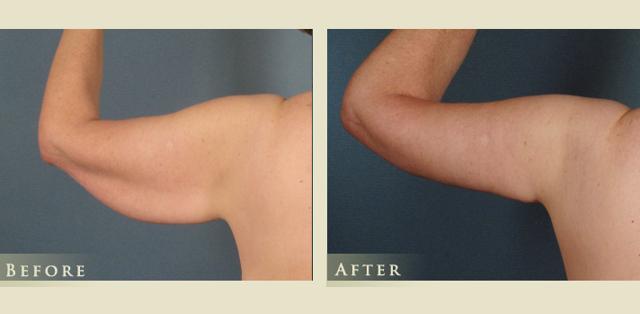 Arm Lift result at Colorado Plastic Surgery in Denver, CO