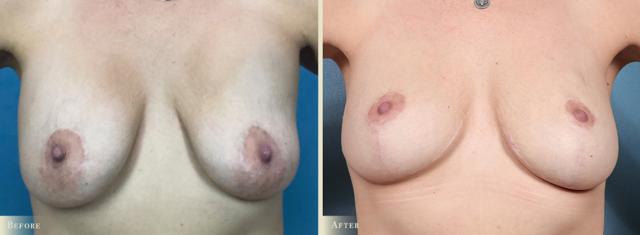 Fat Transfer result at Colorado Plastic Surgery in Denver, CO