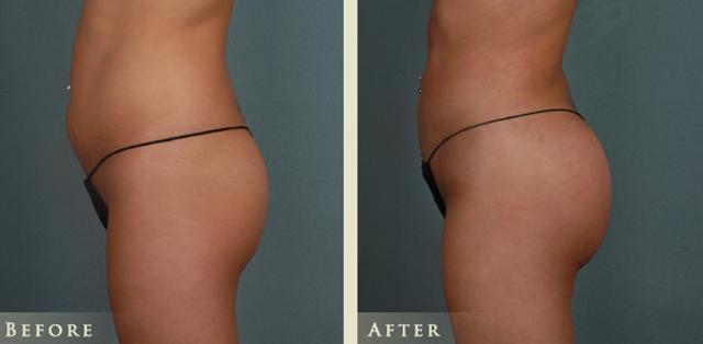 Brazilian Butt Lift result at Colorado Plastic Surgery in Denver, CO