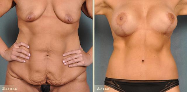 Tummy Tuck result at Colorado Plastic Surgery in Denver, CO