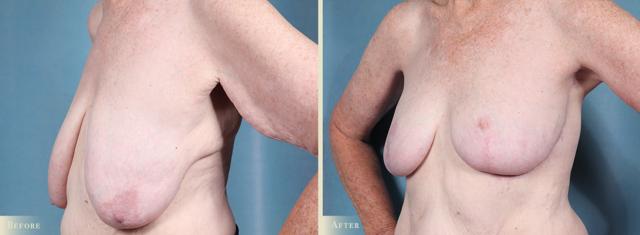 Breast Lift result at Colorado Plastic Surgery in Denver, CO