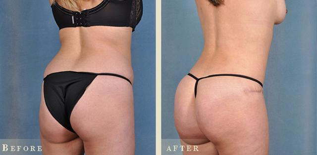 Brazilian Butt Lift result at Colorado Plastic Surgery in Denver, CO