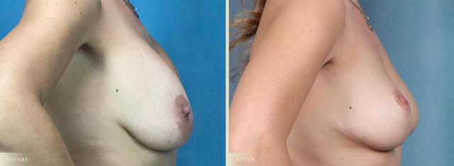 Fat Transfer result at Colorado Plastic Surgery in Denver, CO